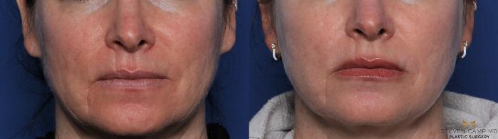 Before & After Sciton Laser Case 446 Front View in Fort Worth & Arlington, Texas