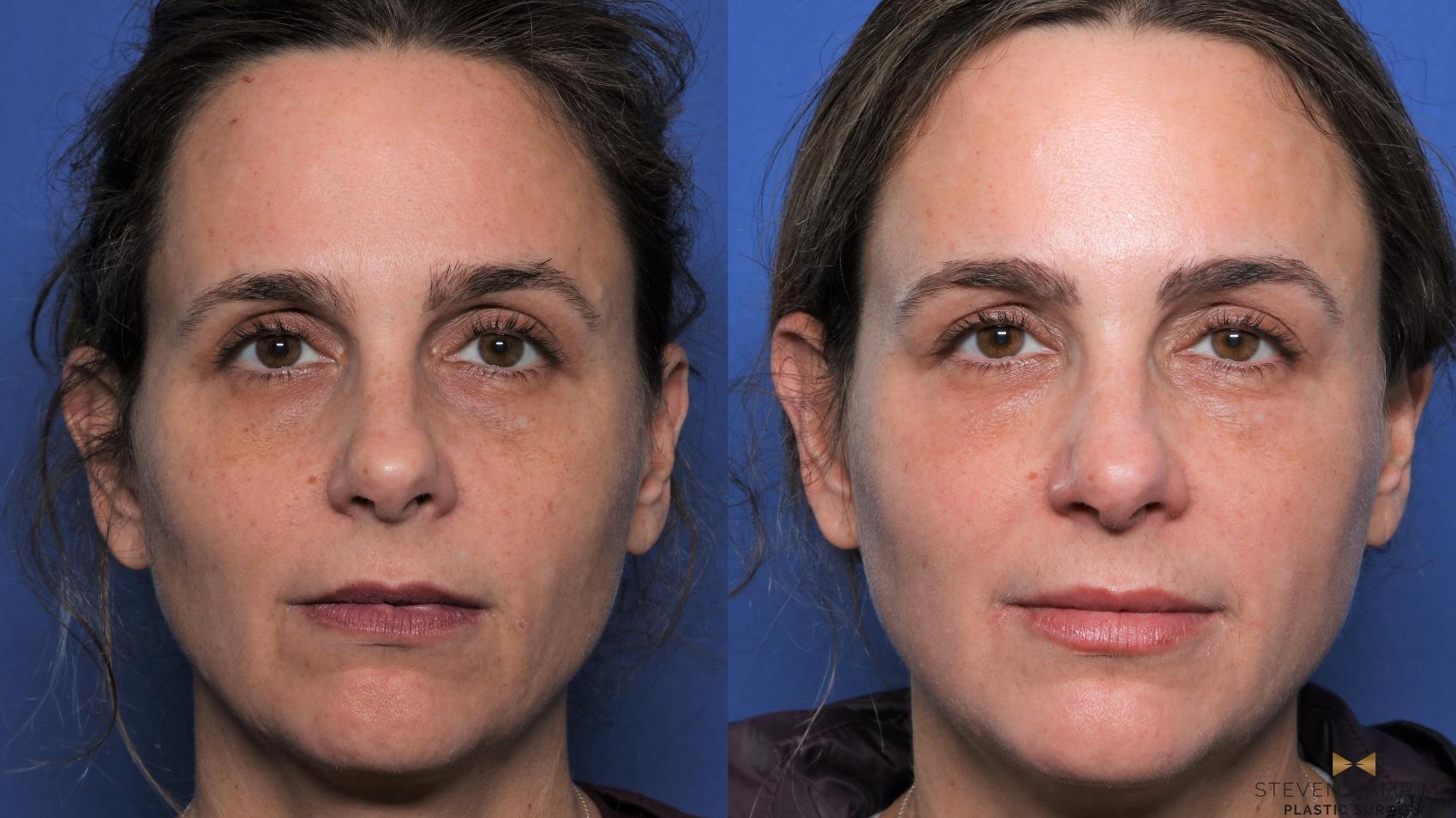 Before & After Sciton Laser Case 447 Front View in Fort Worth & Arlington, Texas