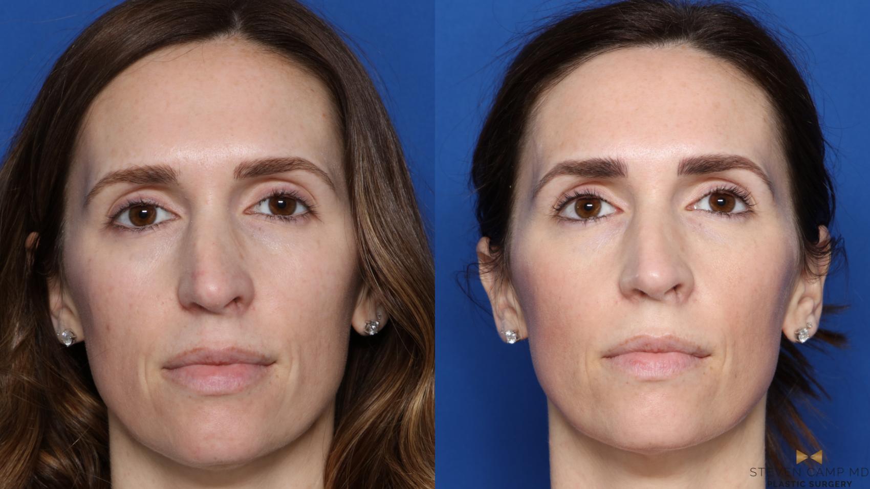 Before & After Sciton Laser Case 448 Front View in Fort Worth, Texas