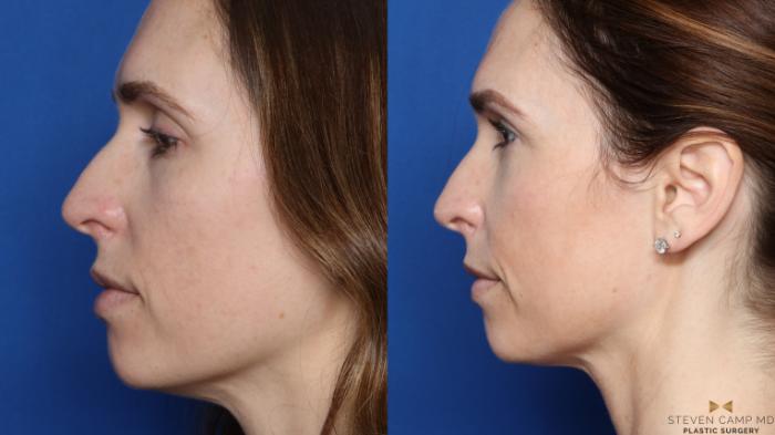 Before & After Sciton Laser Case 448 Left Side View in Fort Worth, Texas