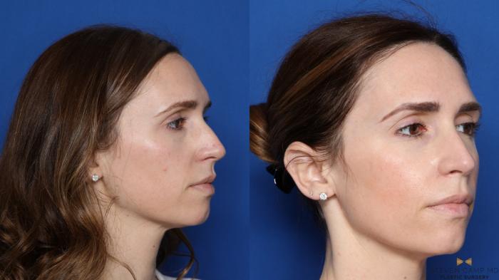 Before & After Sciton Laser Case 448 Right Oblique View in Fort Worth, Texas