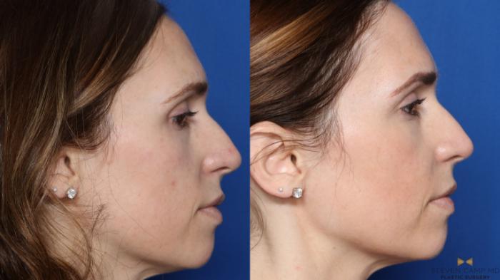 Before & After Sciton Laser Case 448 Right Side View in Fort Worth, Texas