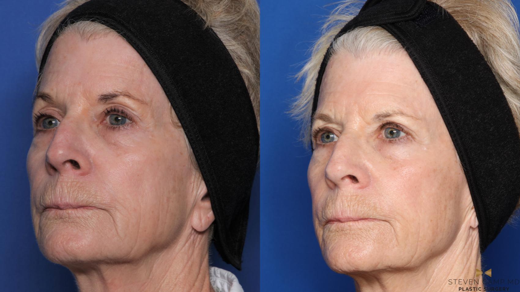 Before & After Sciton Laser Case 450 Right Oblique View in Fort Worth & Arlington, Texas