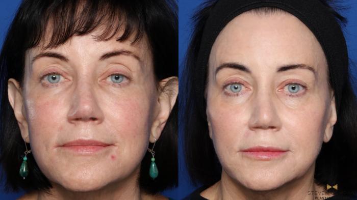 Before & After Sciton Laser Case 451 Front View in Fort Worth, Texas