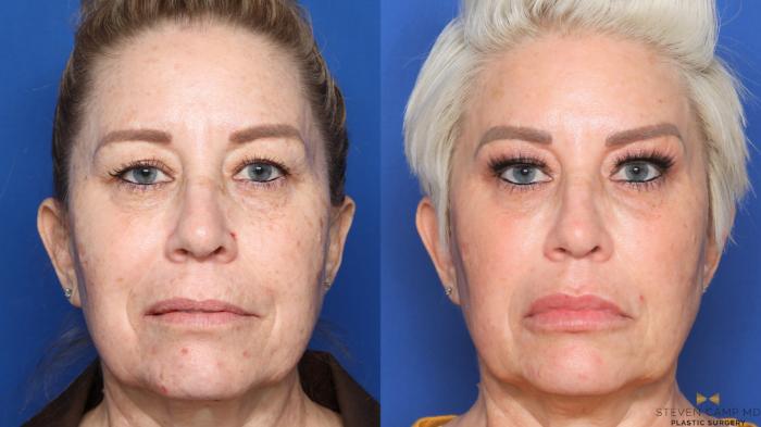 Before & After Sciton Laser Case 452 Front View in Fort Worth, Texas