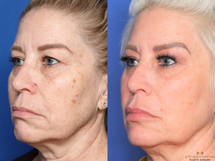 Before & After Sciton Laser Case 452 Left Oblique View in Fort Worth, Texas