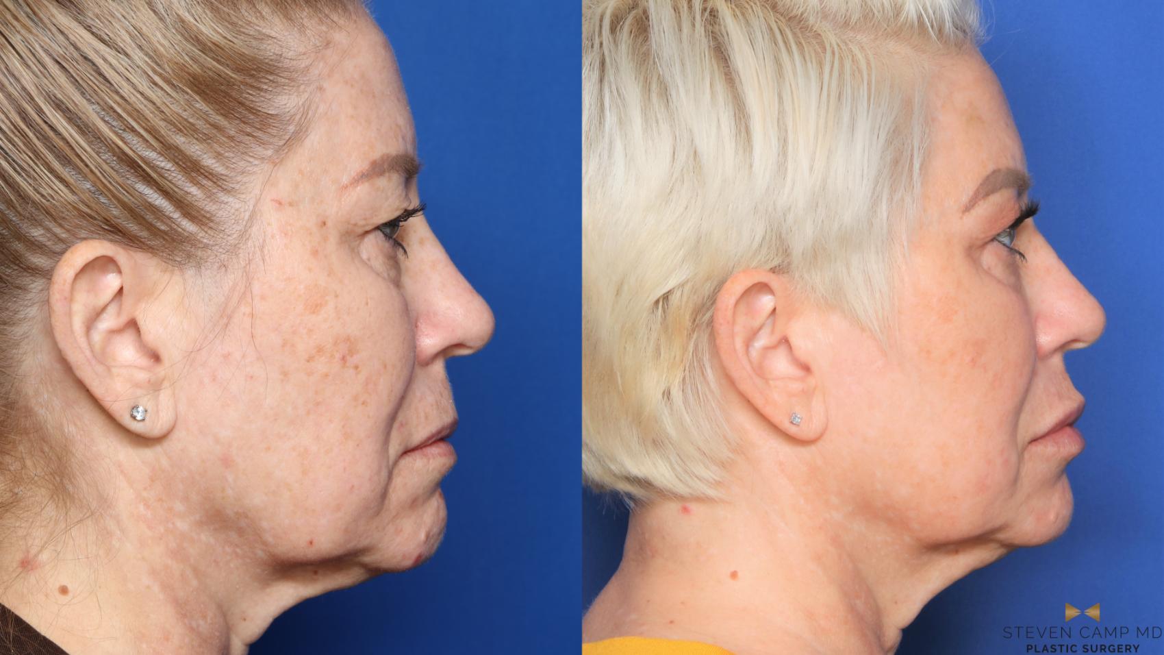 Before & After Sciton Laser Case 452 Right Side View in Fort Worth, Texas