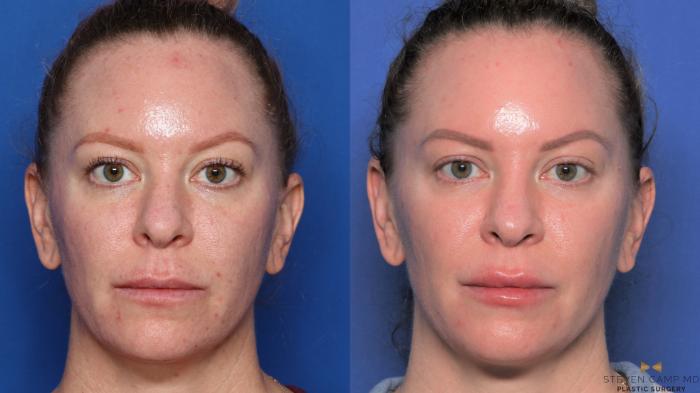 Before & After Sciton Laser Case 455 Front View in Fort Worth & Arlington, Texas