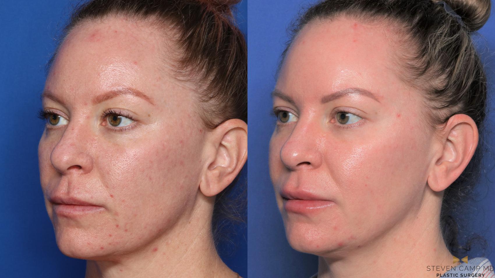 Before & After Sciton Laser Case 455 Left Oblique View in Fort Worth & Arlington, Texas
