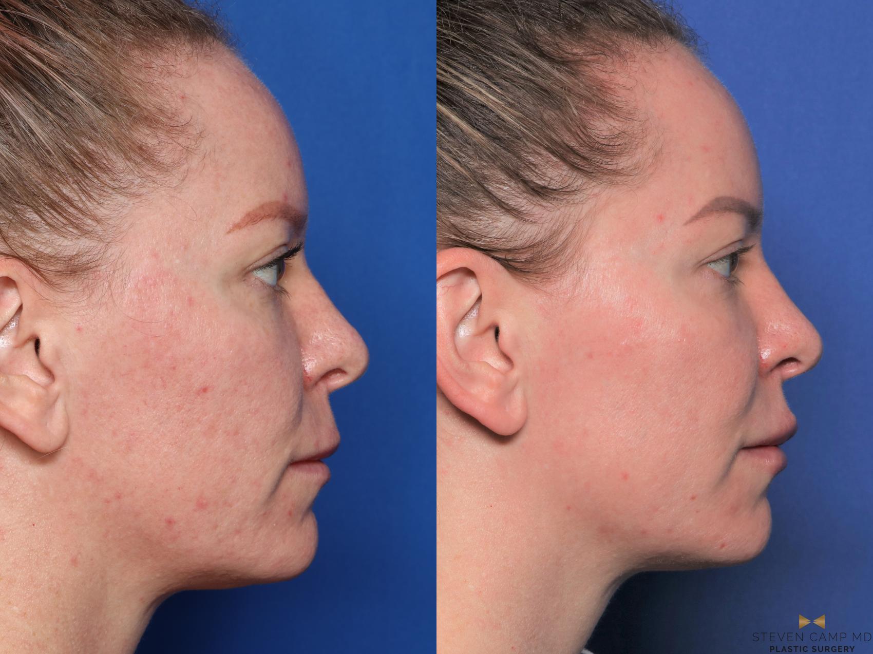 Before & After Sciton Laser Case 455 Left Side View in Fort Worth & Arlington, Texas