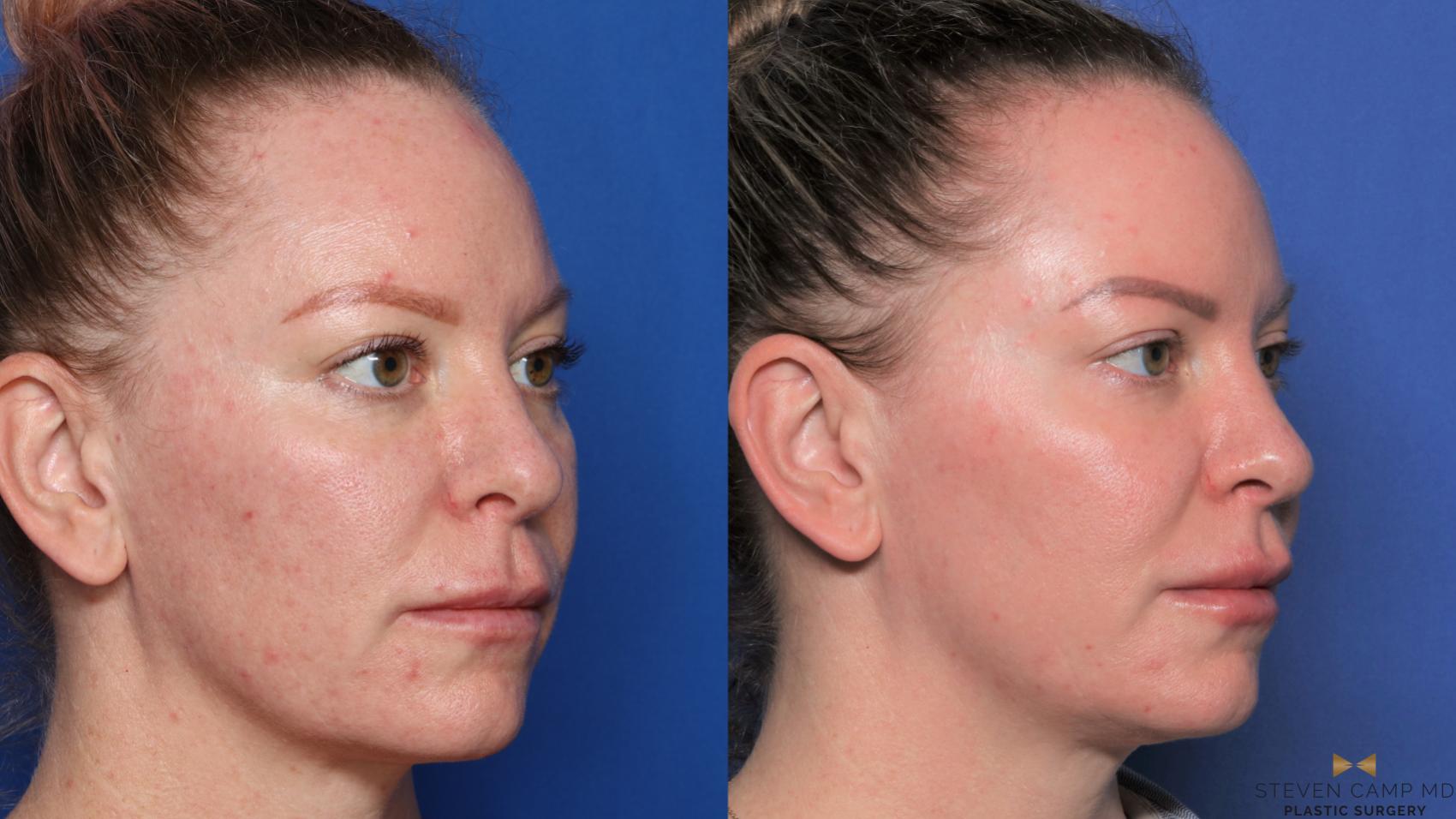 Before & After Sciton Laser Case 455 Right Oblique View in Fort Worth & Arlington, Texas