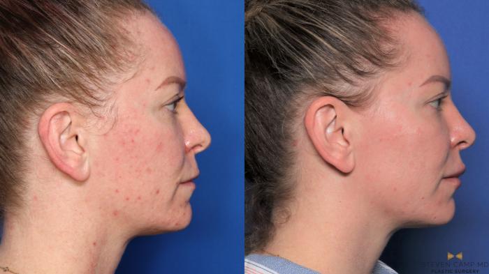Before & After Sciton Laser Case 455 Right Side View in Fort Worth & Arlington, Texas