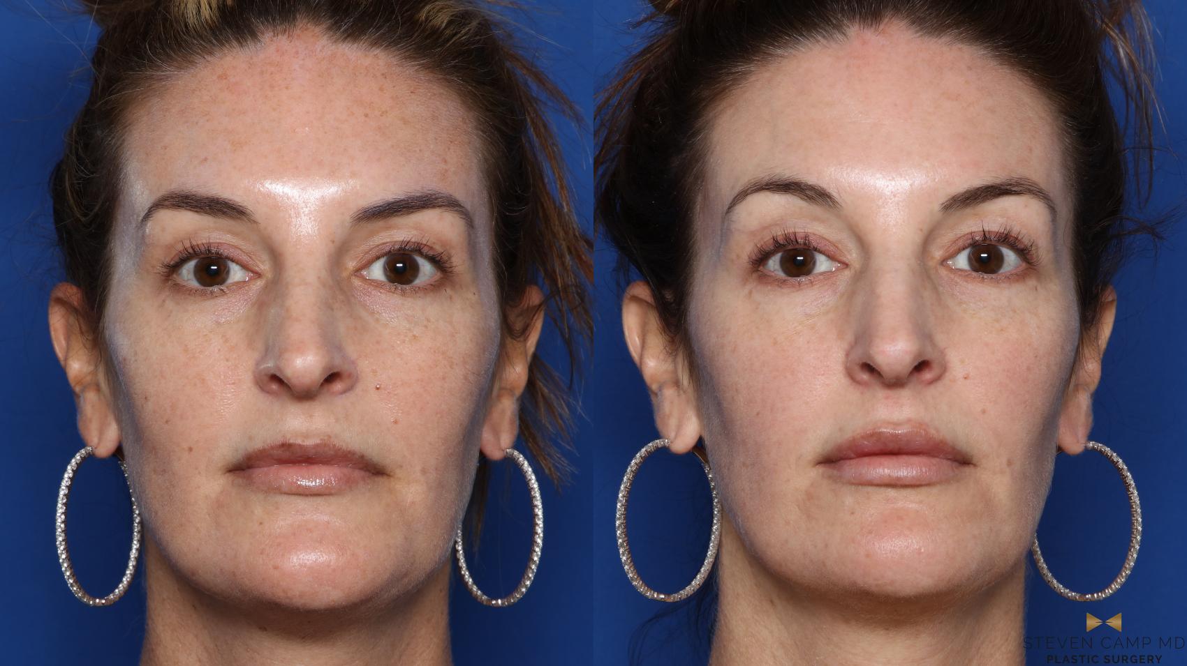 Before & After Sciton Laser Case 468 Front View in Fort Worth & Arlington, Texas