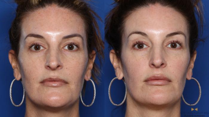 Before & After Sciton Laser Case 468 Front View in Fort Worth, Texas