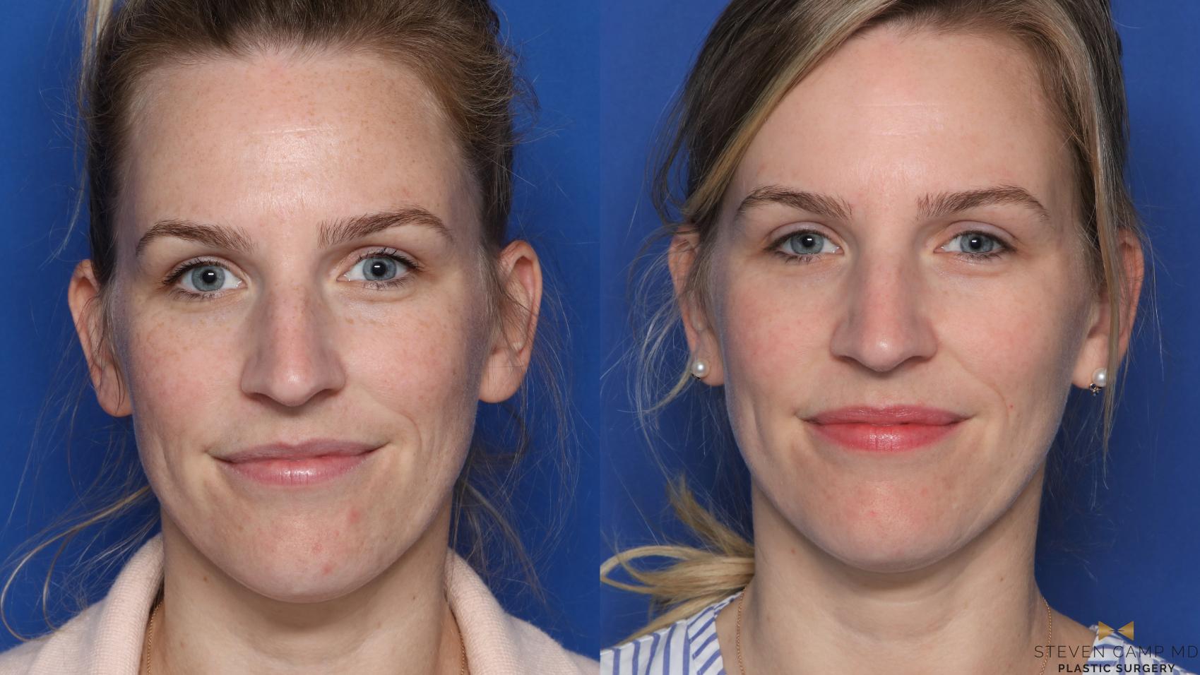 Laser Skin Tightening for Fort Worth & Abeline, TX