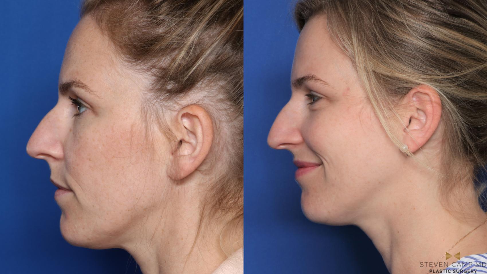 Before & After Sciton Laser Case 476 Left Side View in Fort Worth & Arlington, Texas