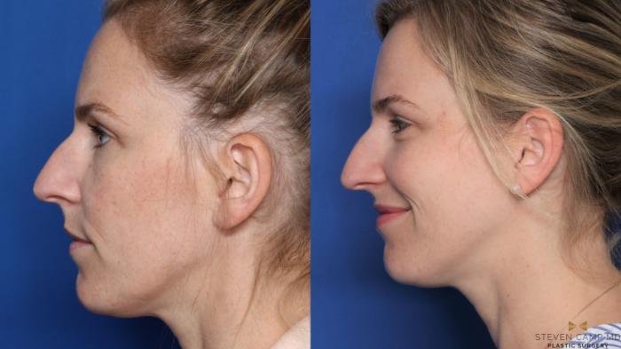 Before & After Sciton Laser Case 476 Left Side View in Fort Worth, Texas