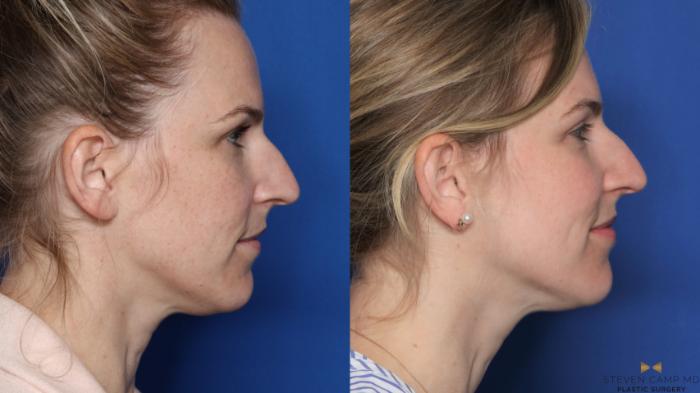 Before & After Sciton Laser Case 476 Right Side View in Fort Worth, Texas
