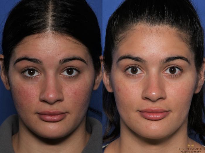 Before & After Sciton Laser Case 477 Front View in Fort Worth, Texas