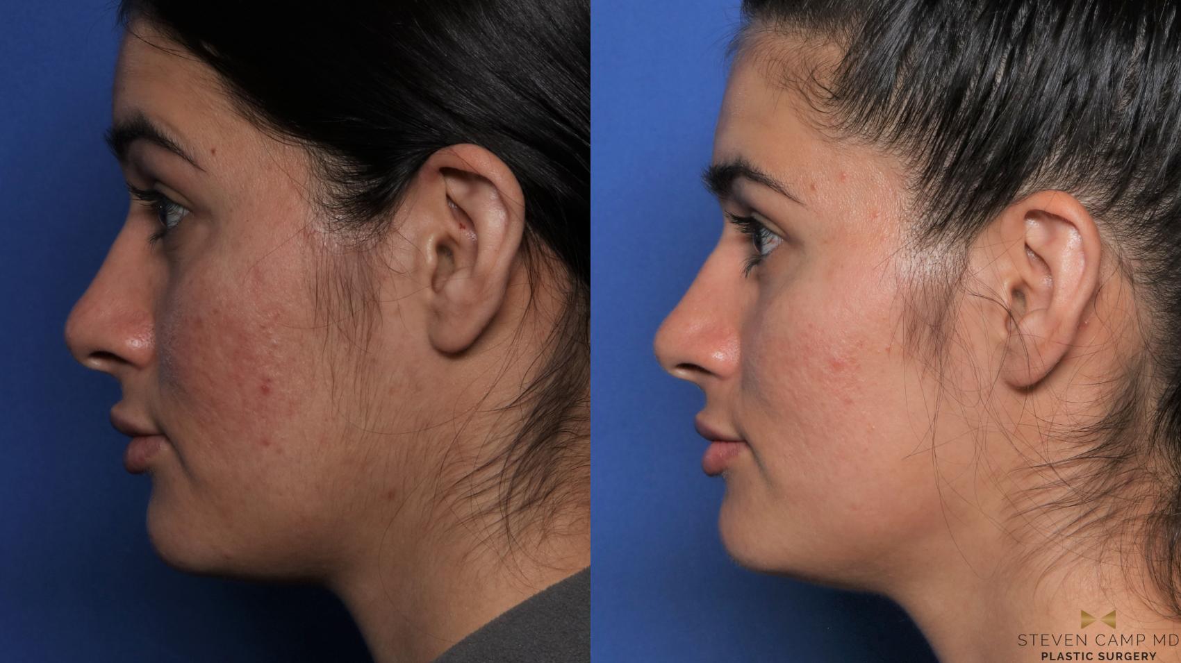 Before & After Sciton Laser Case 477 Left Side View in Fort Worth & Arlington, Texas