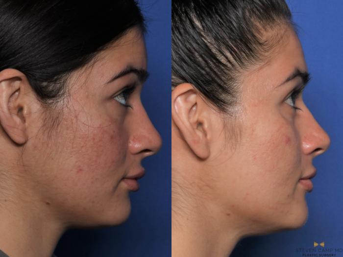 Before & After Sciton Laser Case 477 Right Side View in Fort Worth, Texas