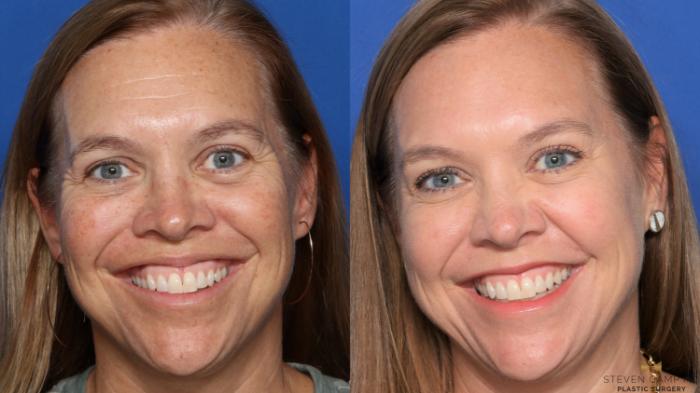 Before & After Sciton Laser Case 478 Front View in Fort Worth & Arlington, Texas