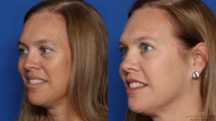 Before & After Sciton Laser Case 478 Left Oblique View in Fort Worth & Arlington, Texas