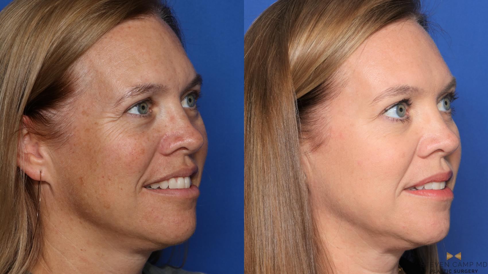 Before & After Sciton Laser Case 478 Right Oblique View in Fort Worth & Arlington, Texas