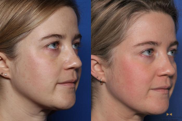 Before & After Sciton Laser Case 487 Left Oblique View in Fort Worth, Texas