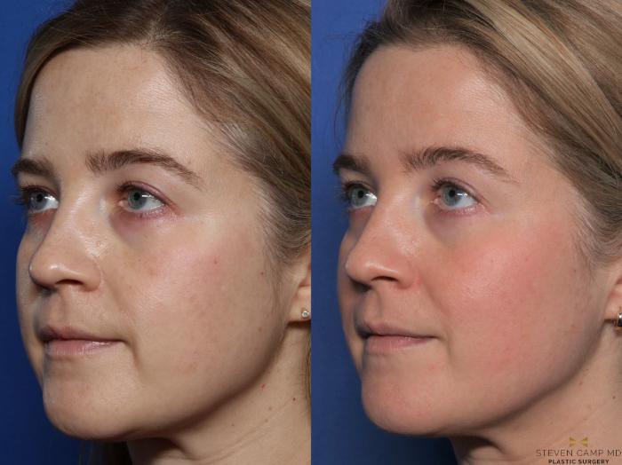 Before & After Sciton Laser Case 487 Left Side View in Fort Worth, Texas