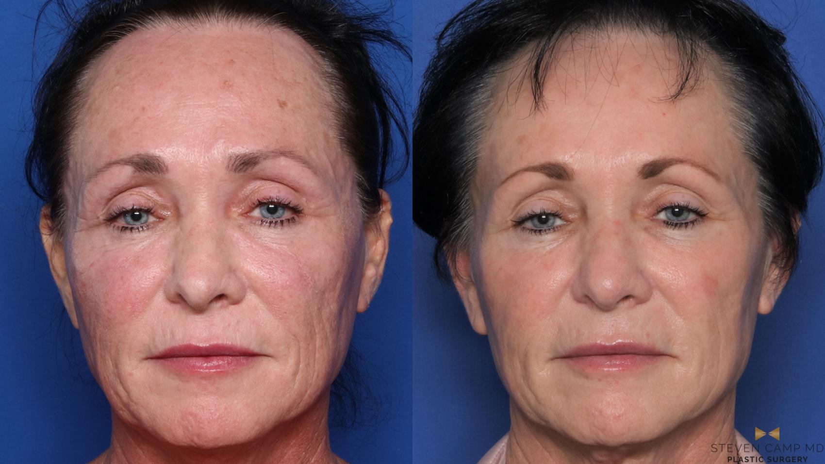Before & After Sciton Laser Case 490 Front View in Fort Worth & Arlington, Texas
