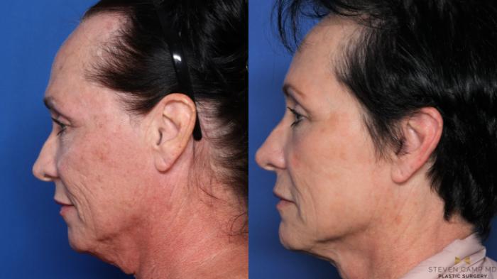Before & After Sciton Laser Case 490 Left Side View in Fort Worth, Texas