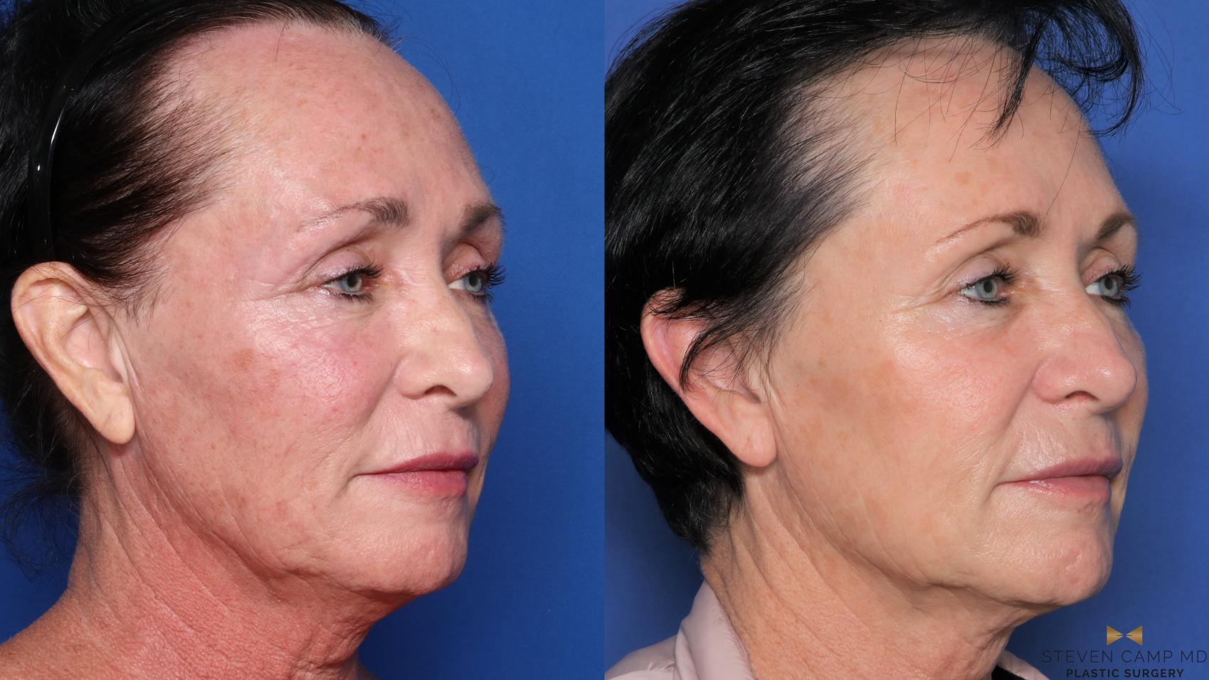 Before & After Sciton Laser Case 490 Right Oblique View in Fort Worth & Arlington, Texas