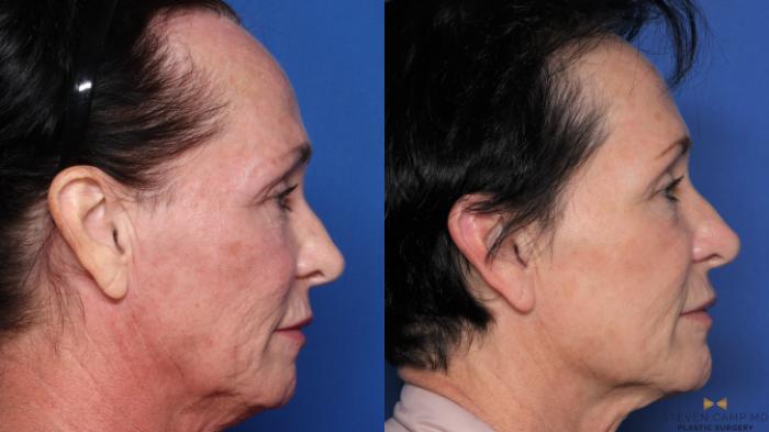 Before & After Sciton Laser Case 490 Right Side View in Fort Worth, Texas