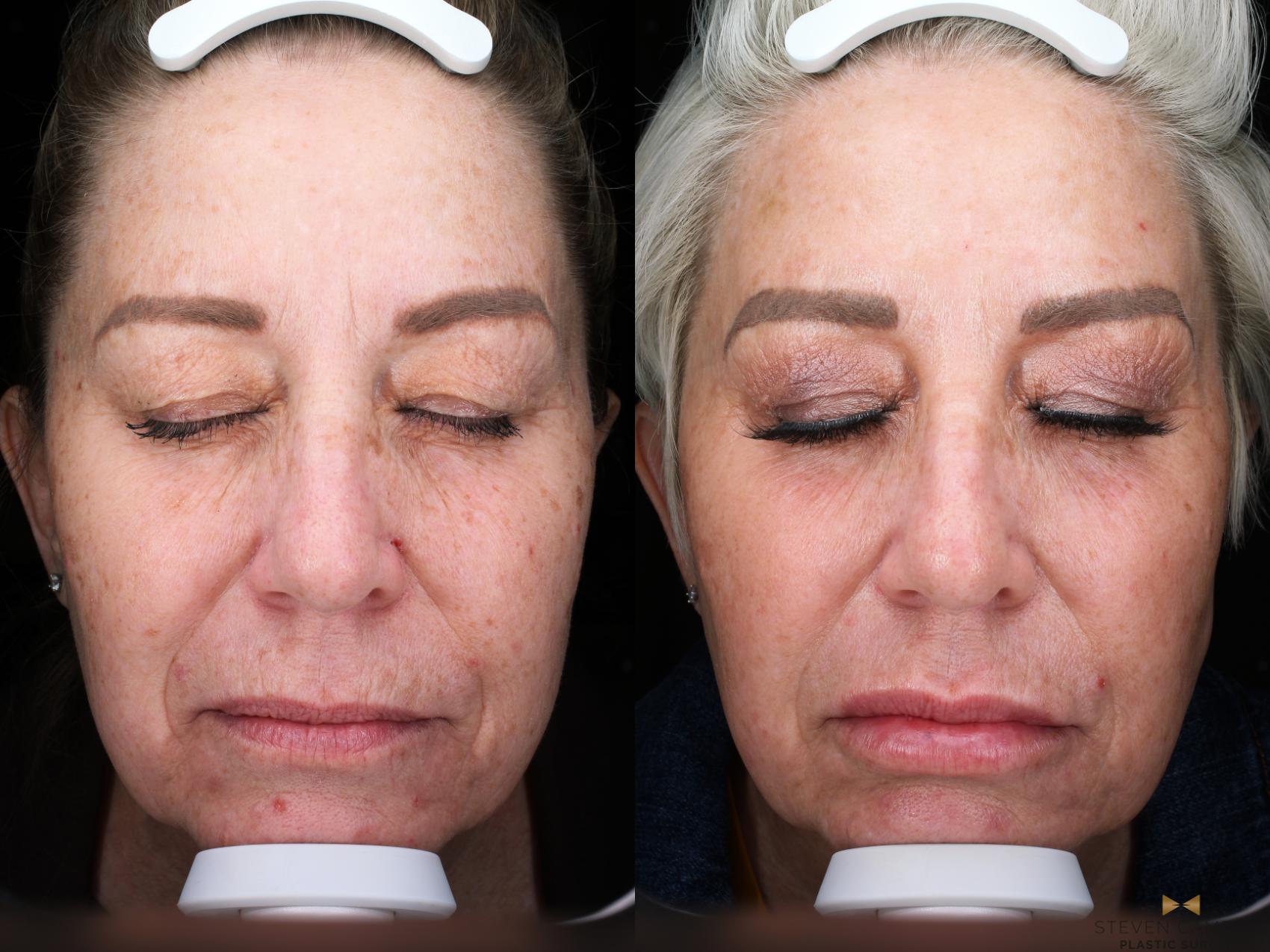 Before & After Sciton Laser Case 503 Front View in Fort Worth & Arlington, Texas