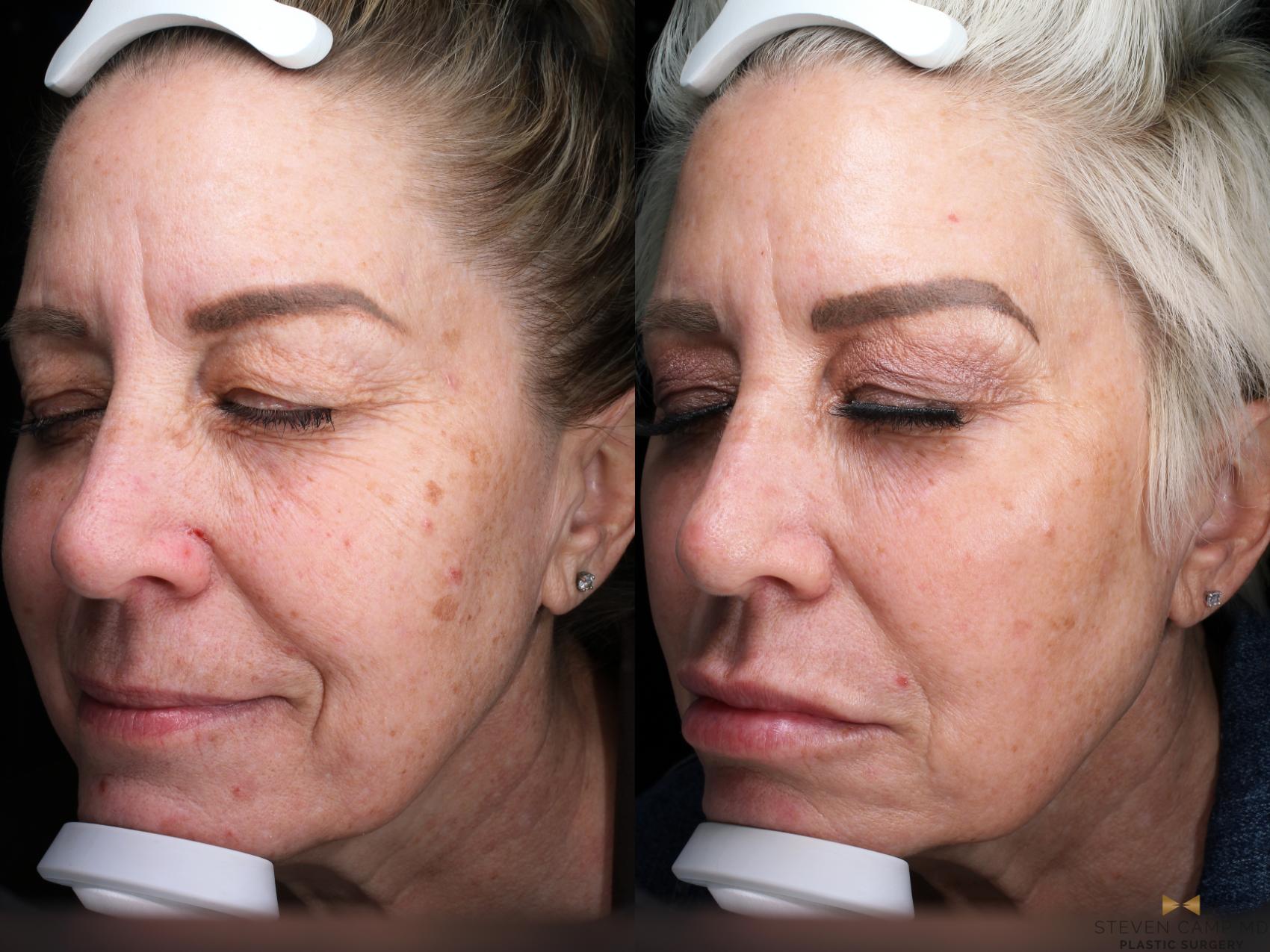 Before & After Sciton Laser Case 503 Left Oblique View in Fort Worth & Arlington, Texas