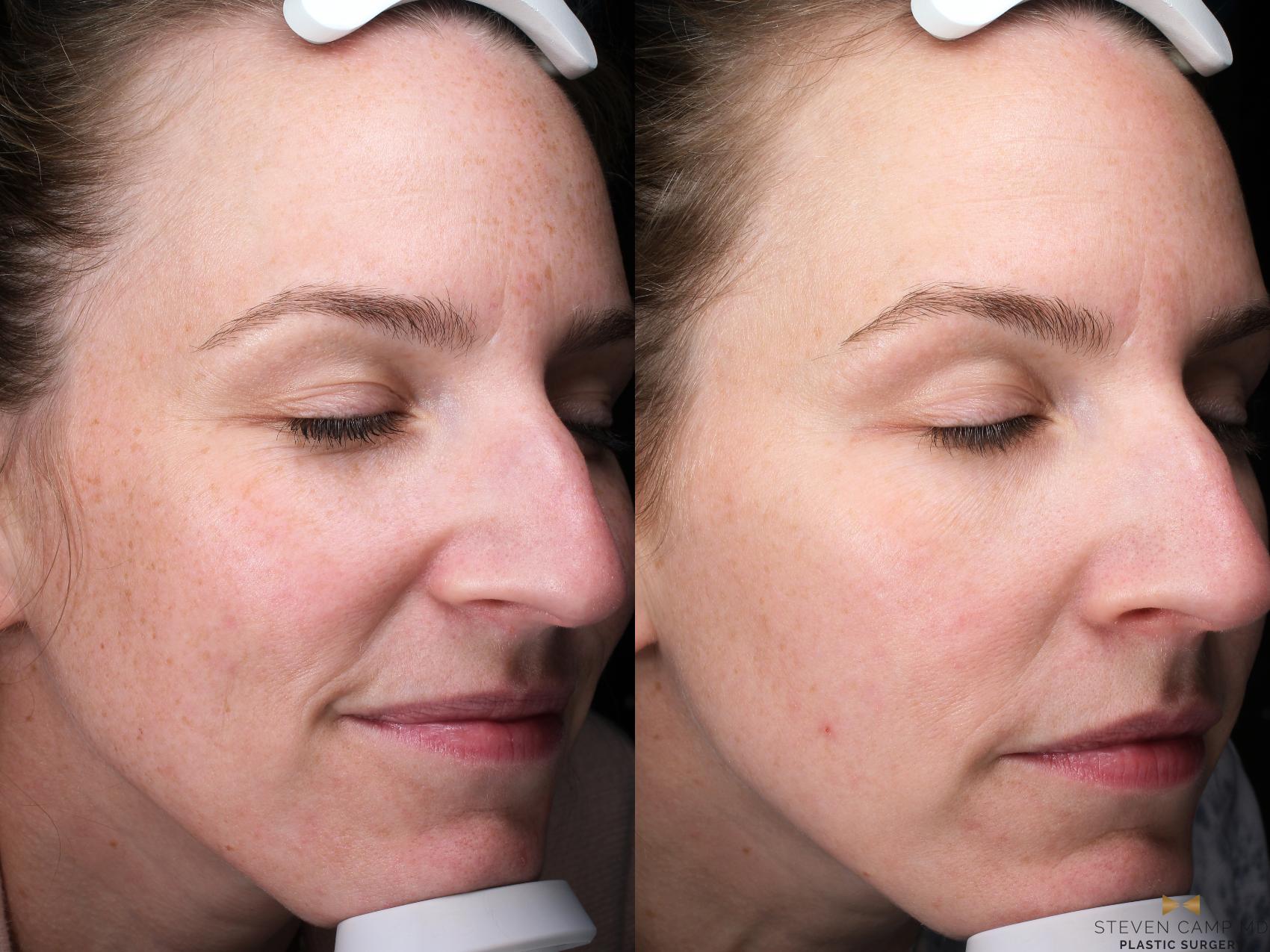 Before & After Sciton Laser Case 504 Right Oblique View in Fort Worth & Arlington, Texas