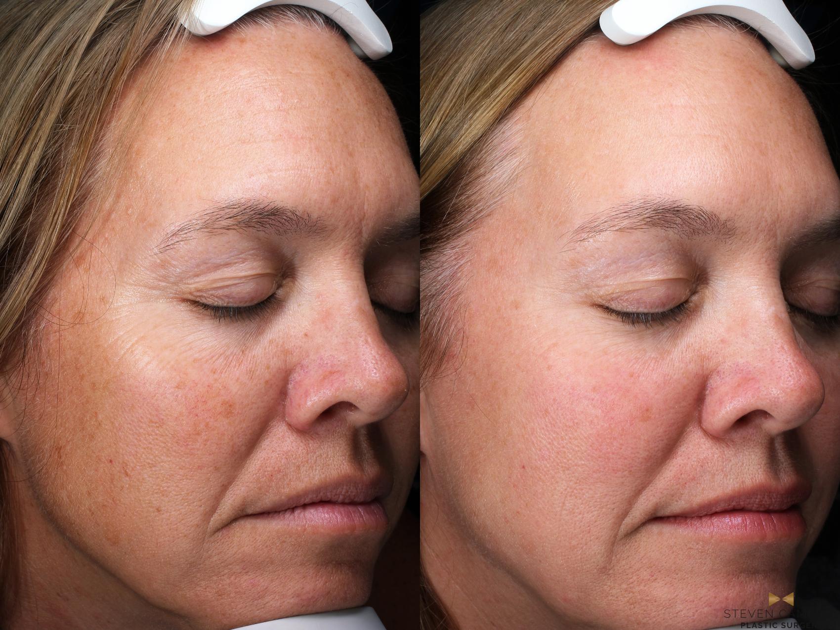 Before & After Sciton Laser Case 505 Right Oblique View in Fort Worth & Arlington, Texas