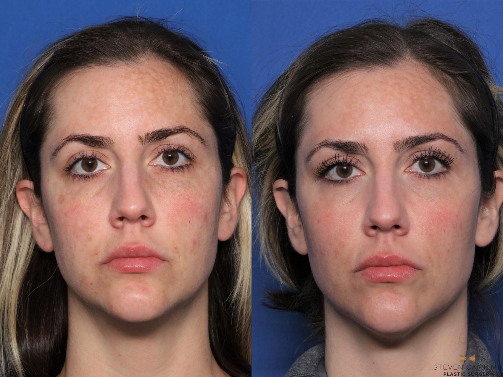 Before & After Sciton Laser Case 512 Front View in Fort Worth, Texas