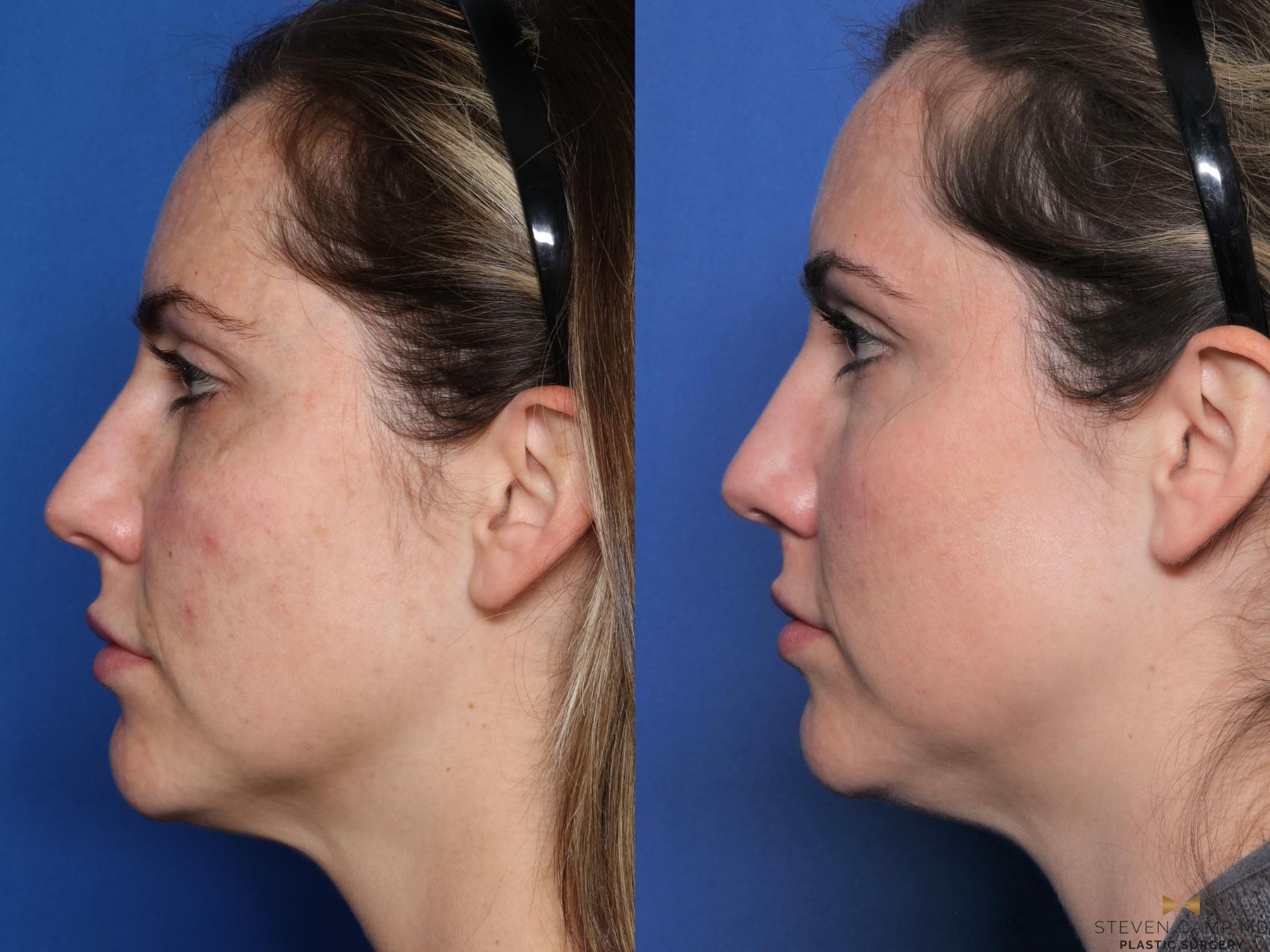Before & After Sciton Laser Case 512 Left Side View in Fort Worth, Texas