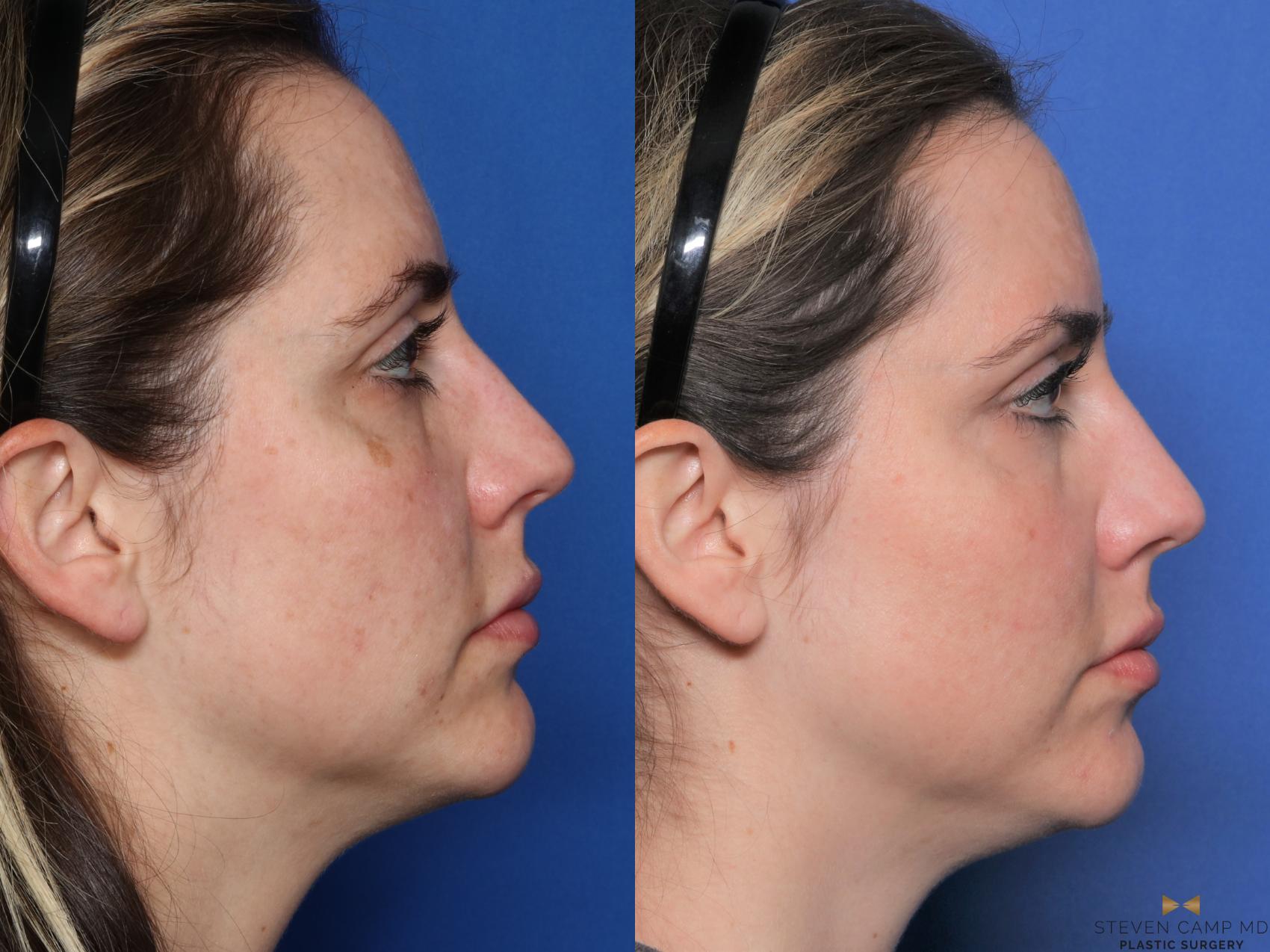 Before & After Sciton Laser Case 512 Right Side View in Fort Worth, Texas
