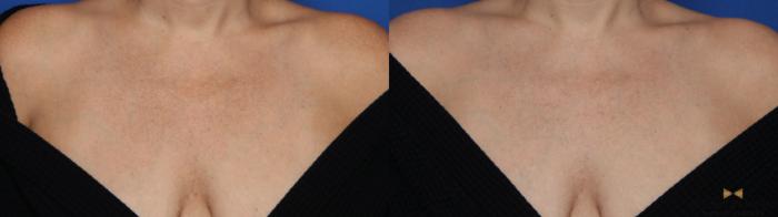 Before & After Sciton Laser Case 514 Front View in Fort Worth & Arlington, Texas