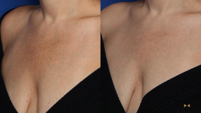Before & After Sciton Laser Case 514 Left Oblique View in Fort Worth & Arlington, Texas