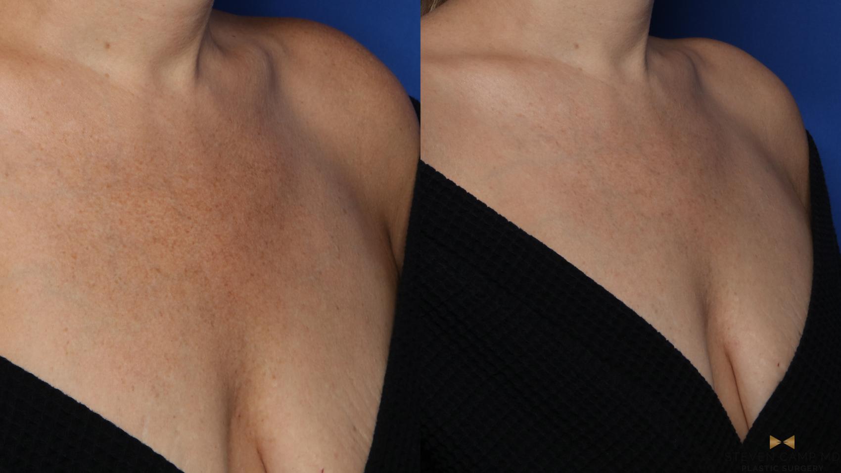 Before & After Sciton Laser Case 514 Right Oblique View in Fort Worth & Arlington, Texas