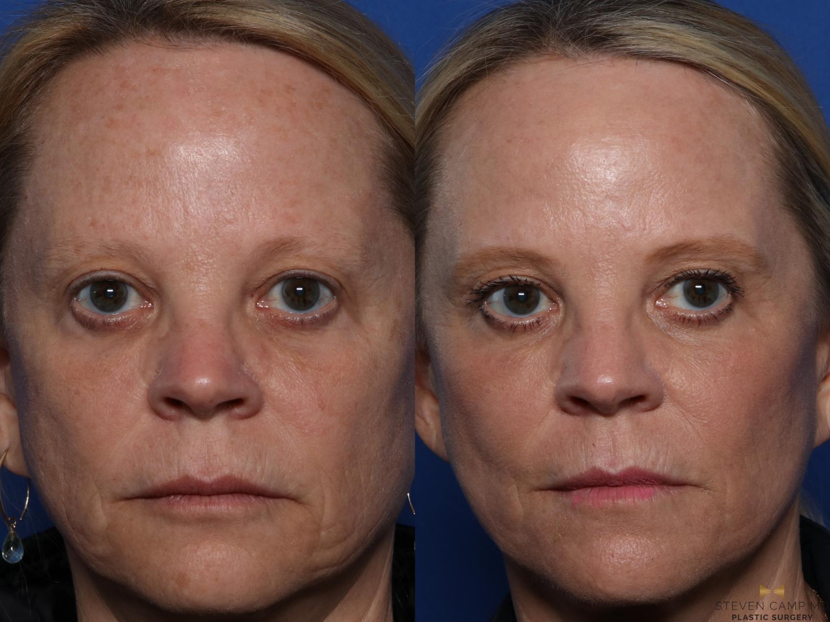 Before & After Sciton Laser Case 522 Front View in Fort Worth & Arlington, Texas