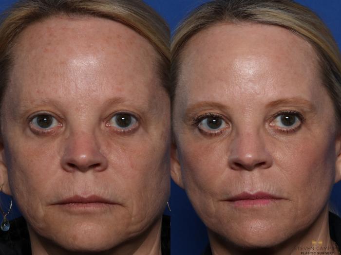 Before & After Sciton Laser Case 522 Front View in Fort Worth, Texas