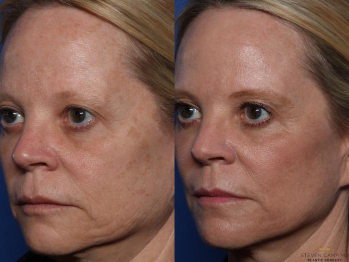 Before & After Sciton Laser Case 522 Left Oblique View in Fort Worth, Texas
