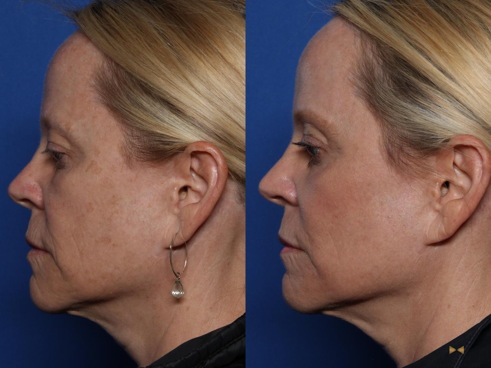 Before & After Sciton Laser Case 522 Left Side View in Fort Worth & Arlington, Texas