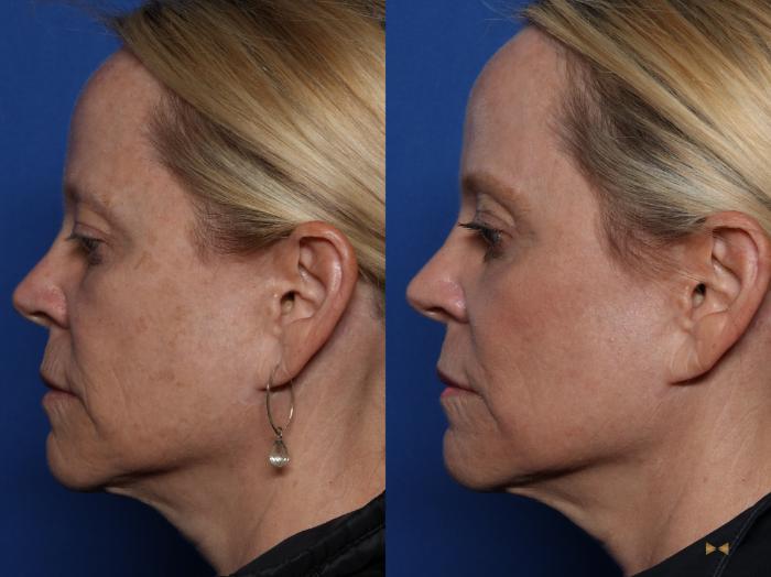Before & After Sciton Laser Case 522 Left Side View in Fort Worth, Texas