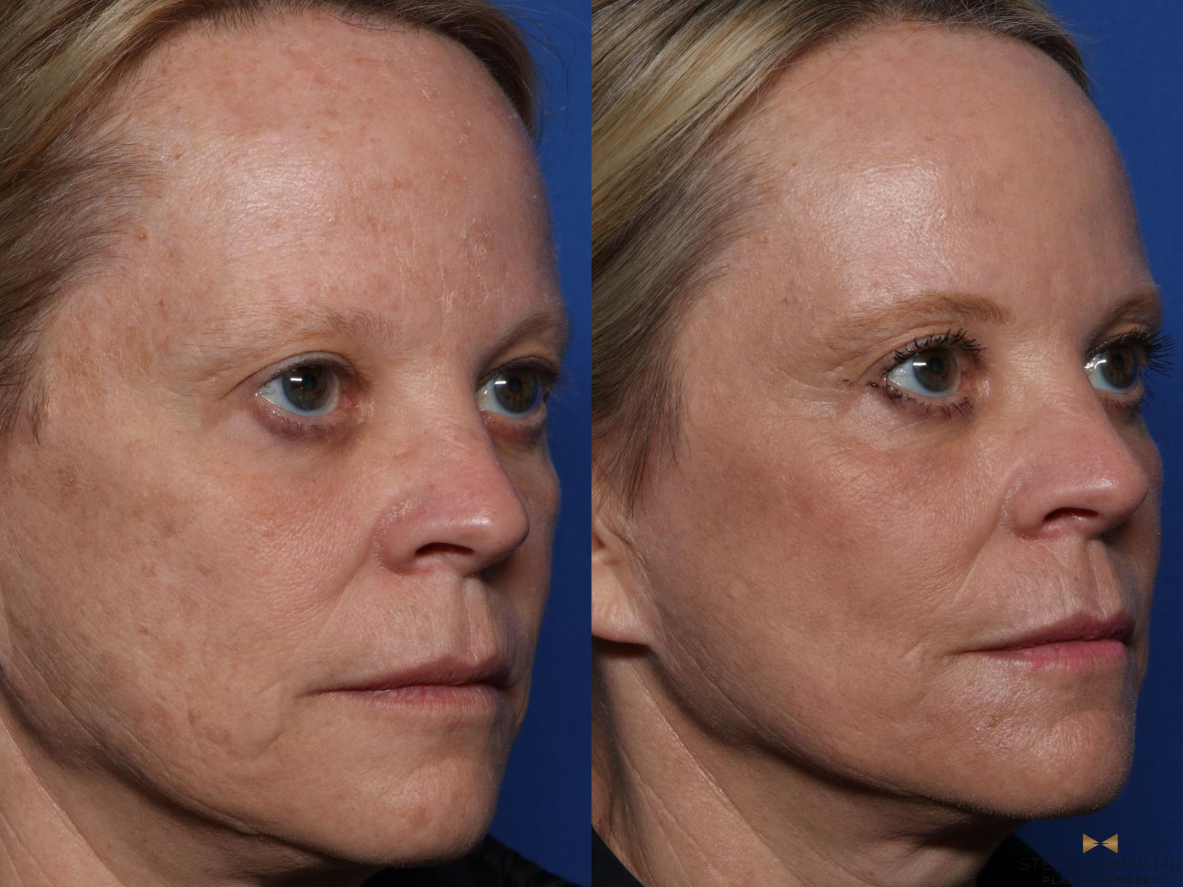 Before & After Sciton Laser Case 522 Right Oblique View in Fort Worth & Arlington, Texas